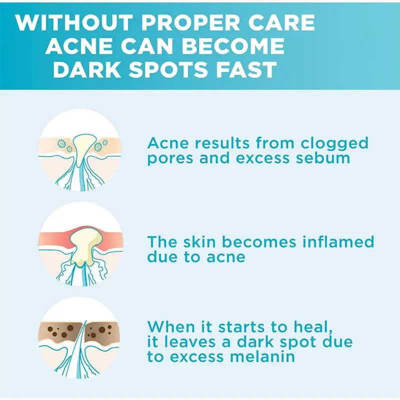 Anti-Acne Face Serum